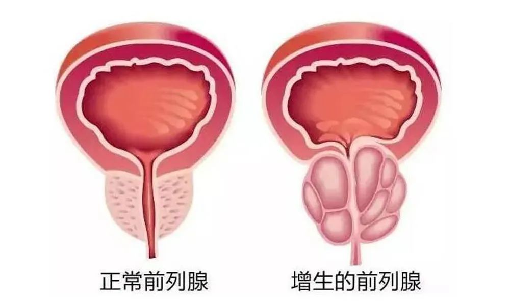 四川瑞梦热蒸汽治疗前列腺医院：前列腺增生能治吗?怎么治?(图2)