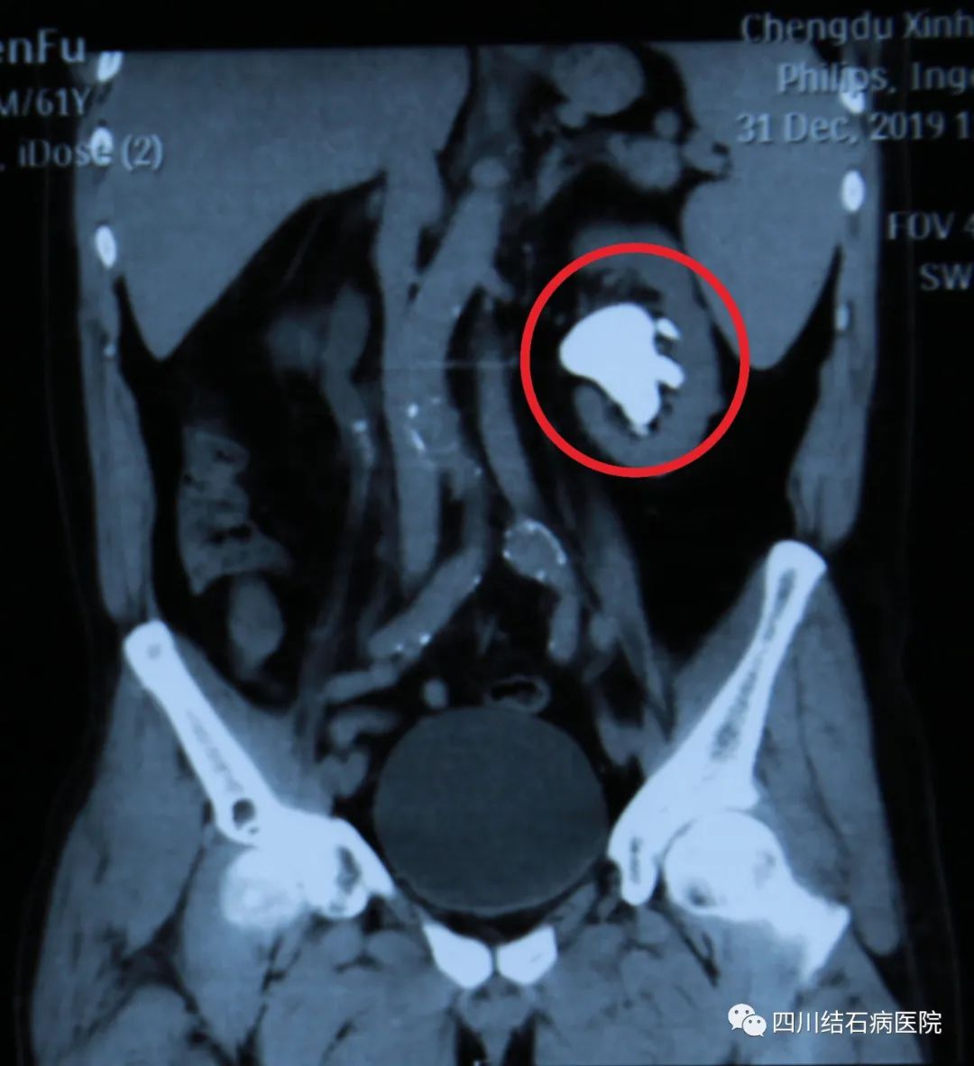 四川肾结石医院案例分享：罕见！男子左肾长出8公分巨型结石(图1)