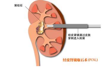 四川肾结石医院案例分享：罕见！男子左肾长出8公分巨型结石(图3)