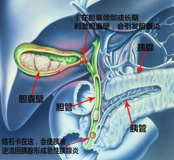 成都胆结石医院：你知道正常胆囊多大？如果胆囊增大了又怎么办？(图2)