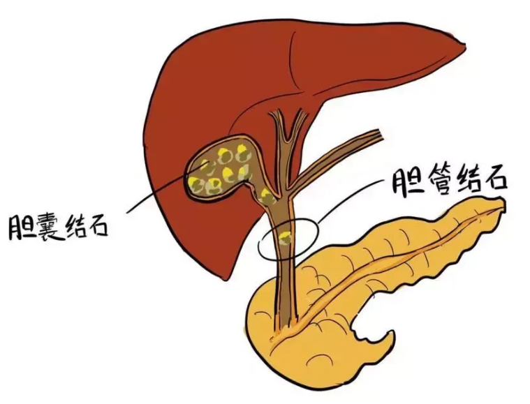 成都胆结石医院：你知道正常胆囊多大？如果胆囊增大了又怎么办？(图3)