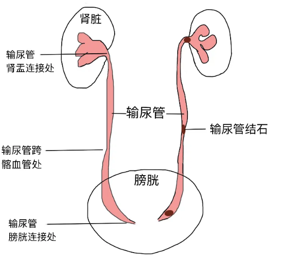 成都肾结石医院揭秘：肾结石四大常见误区 快来看看你中招了吗？(图3)