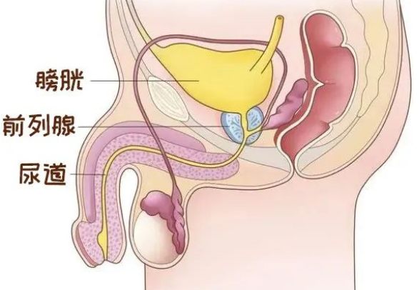 @四川前列腺增生患者：瑞梦热蒸汽消融术 数分钟解决前列腺增生(图1)