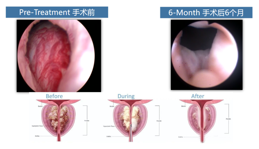 四川瑞梦中心：前列腺增生真相大揭秘，那些不得不解释的误会！(图3)