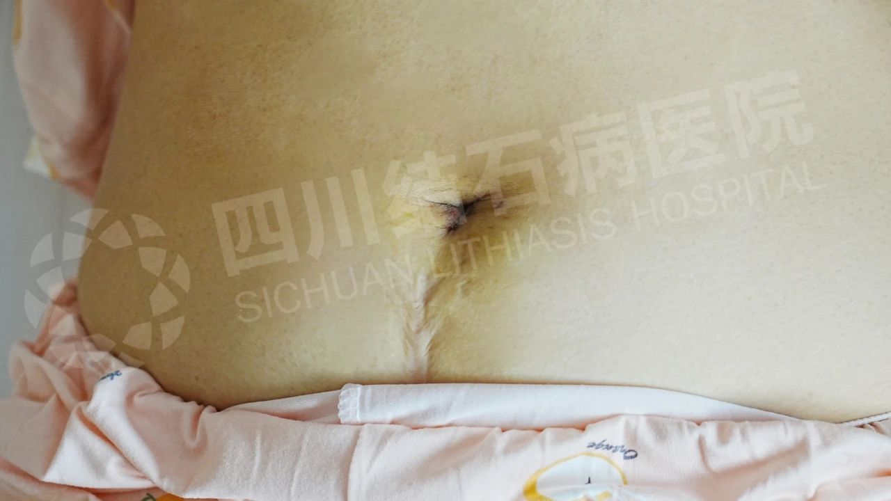 跨越九年的保胆路：一对夫妻见证从「微创」到「超微创隐形」的技术进步(图1)