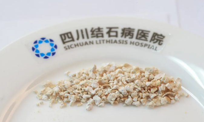 建议收藏！肾结石患者最关心的8大问题，一次性讲清楚！【四川肾结石专科医院】(图2)
