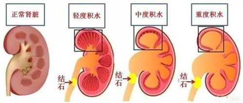 建议收藏！肾结石患者最关心的8大问题，一次性讲清楚！【四川肾结石专科医院】(图3)