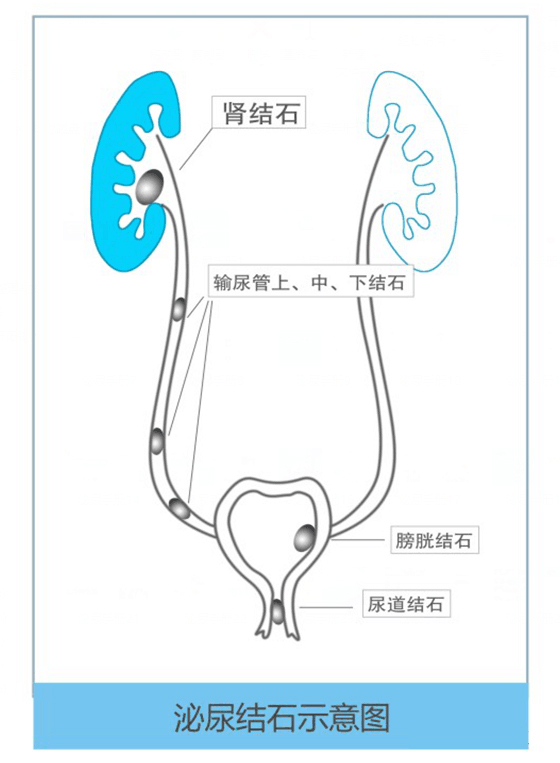 身体出现这4个症状，是肾脏的求救信号【四川肾结石专科医院】(图1)