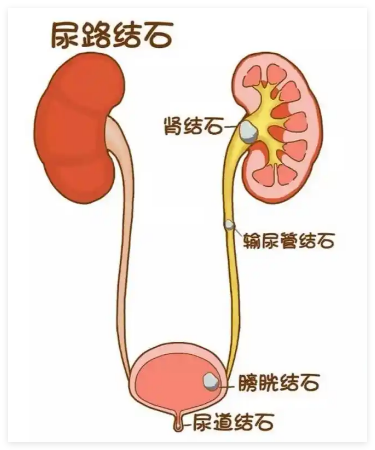 当心！出现这些症状可能提示泌尿结石，务必及时排查！【成都24小时碎石医院】(图1)