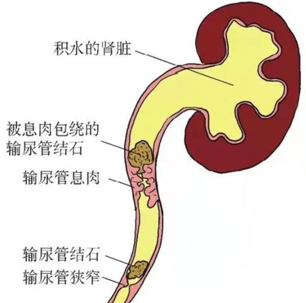 结石手术做了白做，反正还会长？泌尿外科专家提醒：别让误解耽误了健康！(图3)