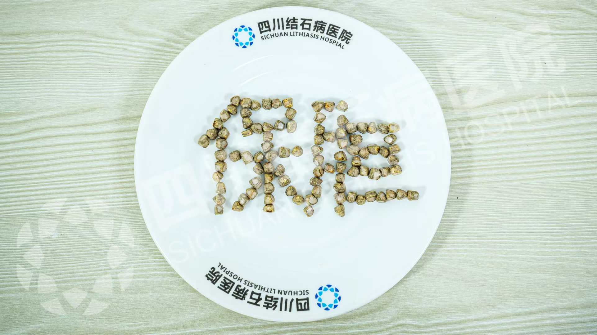 五天三例!四川结石病医院接连取出126颗、275颗、1343颗结石(图1) 五天三例!四川结石病医院接连取出126颗、275颗、1343颗结石(图1)