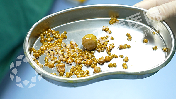 五天三例!四川结石病医院接连取出126颗、275颗、1343颗结石(图2) 五天三例!四川结石病医院接连取出126颗、275颗、1343颗结石(图2)