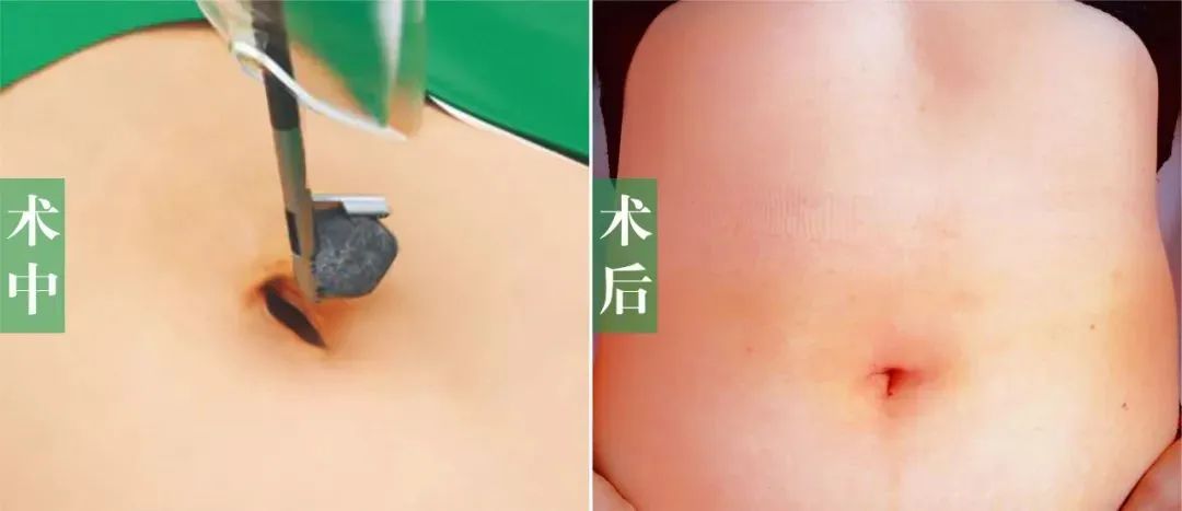 警惕！结石长期不重视可能癌变，这2个高危饮食习惯赶紧改【四川胆结石专科医院】(图4)