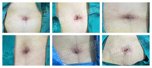 警惕！结石长期不重视可能癌变，这2个高危饮食习惯赶紧改【四川胆结石专科医院】(图5)