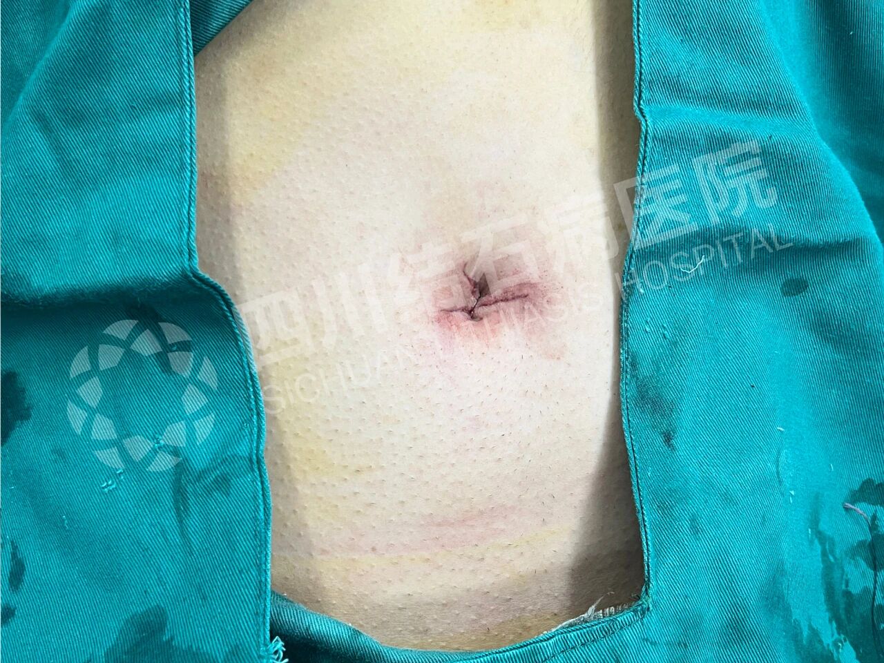 怕留疤？怕切胆？经脐隐瘢痕技术实现“鱼与熊掌兼得”【四川结石病医院】(图4)