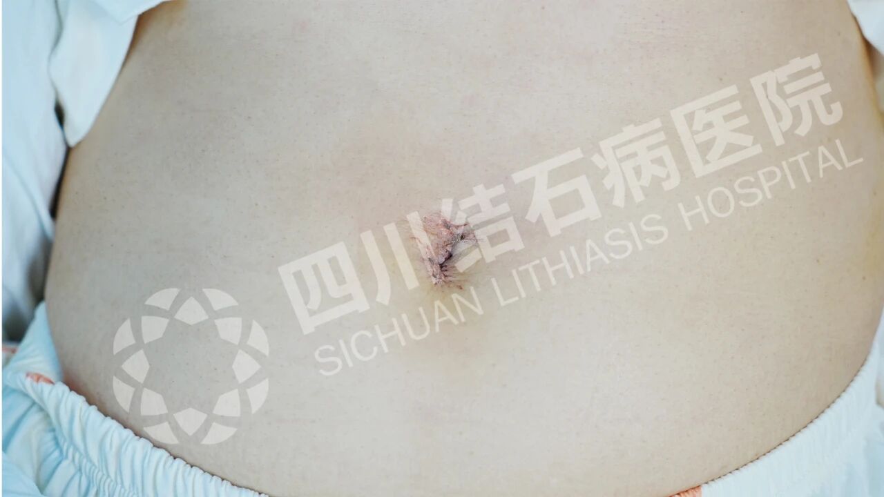 怕留疤？怕切胆？经脐隐瘢痕技术实现“鱼与熊掌兼得”【四川结石病医院】(图5)