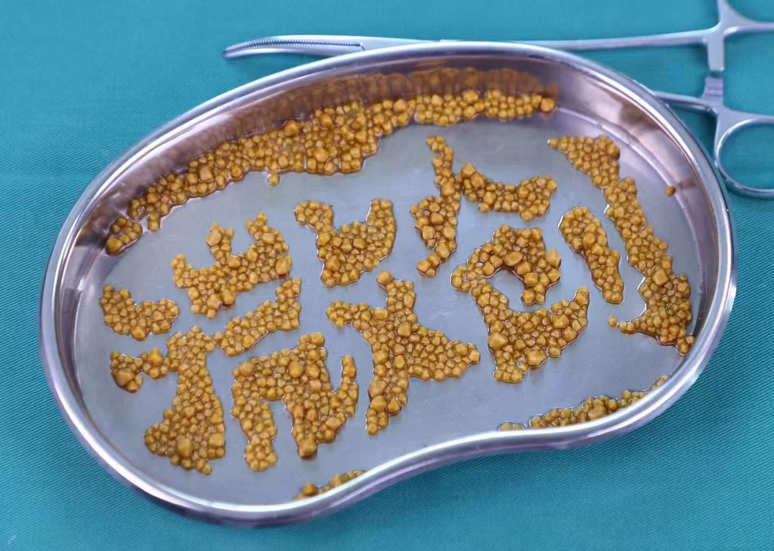 一文读懂肾结石5个发展阶段,早发现、早治疗,越到后面越危险!(图3) 一文读懂肾结石5个发展阶段,早发现、早治疗,越到后面越危险!(图3)