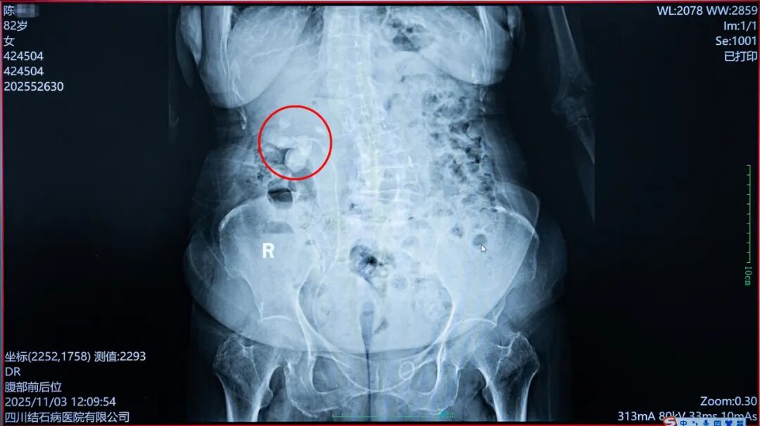 八旬奶奶“除石”记：当右肾铸型结石遇上医者仁心【四川结石病医院】(图4)