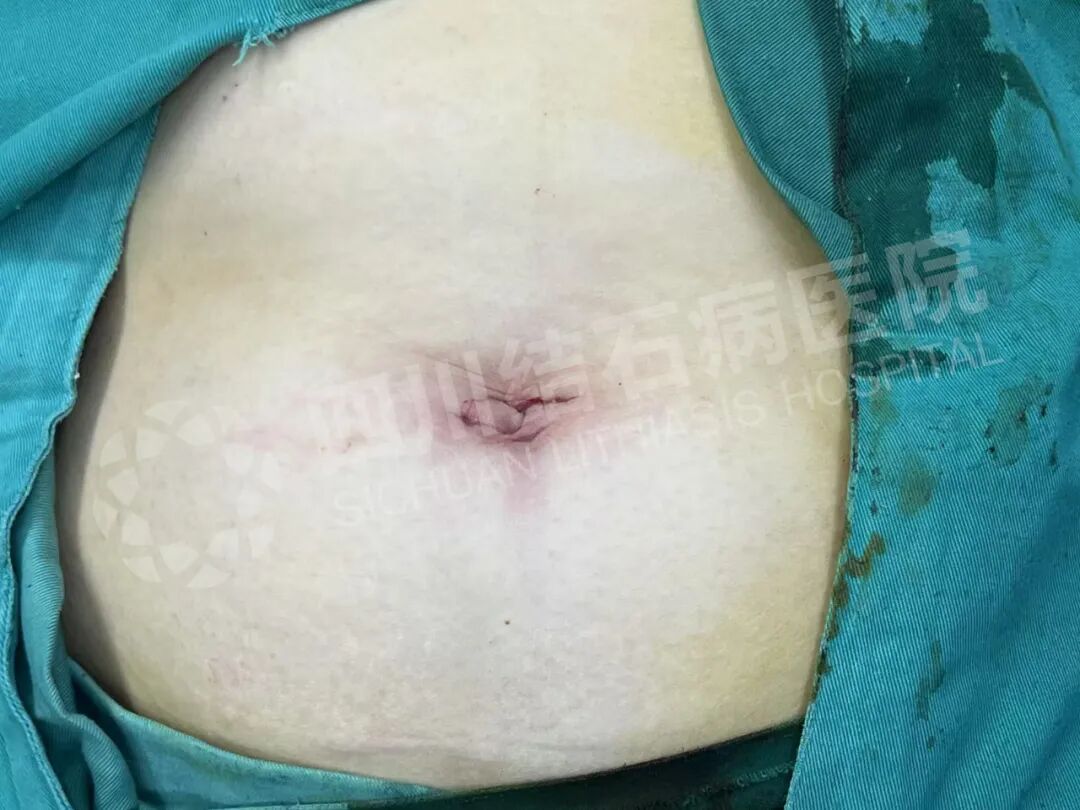 四川结石病医院：节后结石患者“扎堆”，这些“元凶”你得防！(图3)