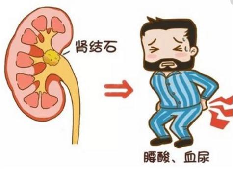 泌尿结石突然发作,该如何“自救”?|四川结石病医院(图1) 泌尿结石突然发作,该如何“自救”?|四川结石病医院(图1)