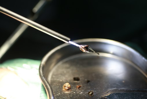 90%的人都中招！肾结石三大致命谣言，泌尿外科主任一次说清(图2)