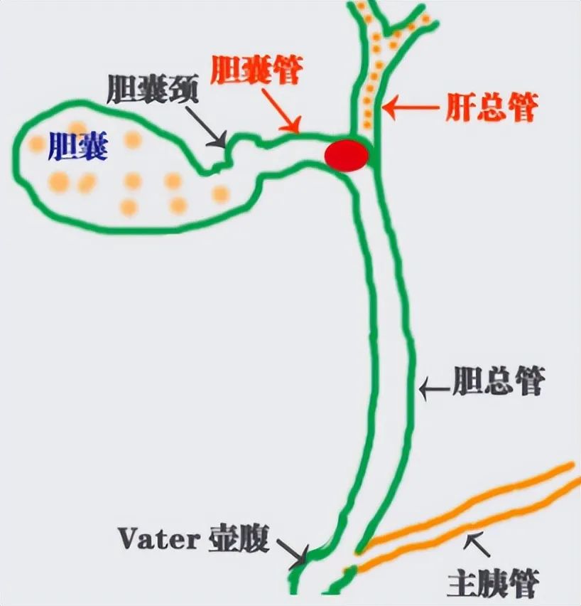 胆囊结石科学处理指南：无症状期，为什么首推“保胆取石”?(图1)