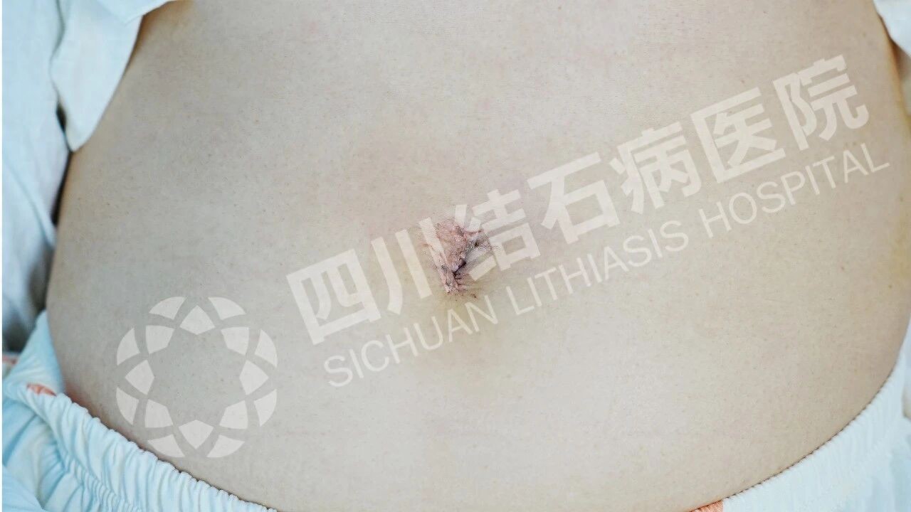 @胆结石患者：决定切胆前，要先了解这些术后风险再决定！(图3)