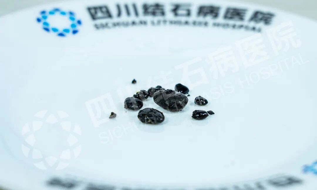 能不能保胆,关键看什么?四川保胆取石医院(图1) 能不能保胆,关键看什么?四川保胆取石医院(图1)