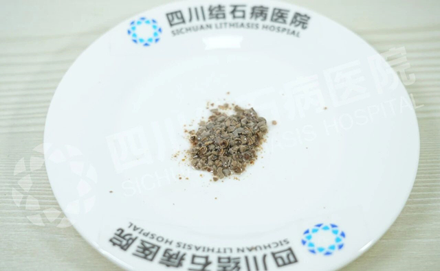 吓人!输尿管竟成“结石窝”!如何端掉这个“老巢”?【成都保肾取石医院】(图2) 吓人!输尿管竟成“结石窝”!如何端掉这个“老巢”?【成都保肾取石医院】(图2)