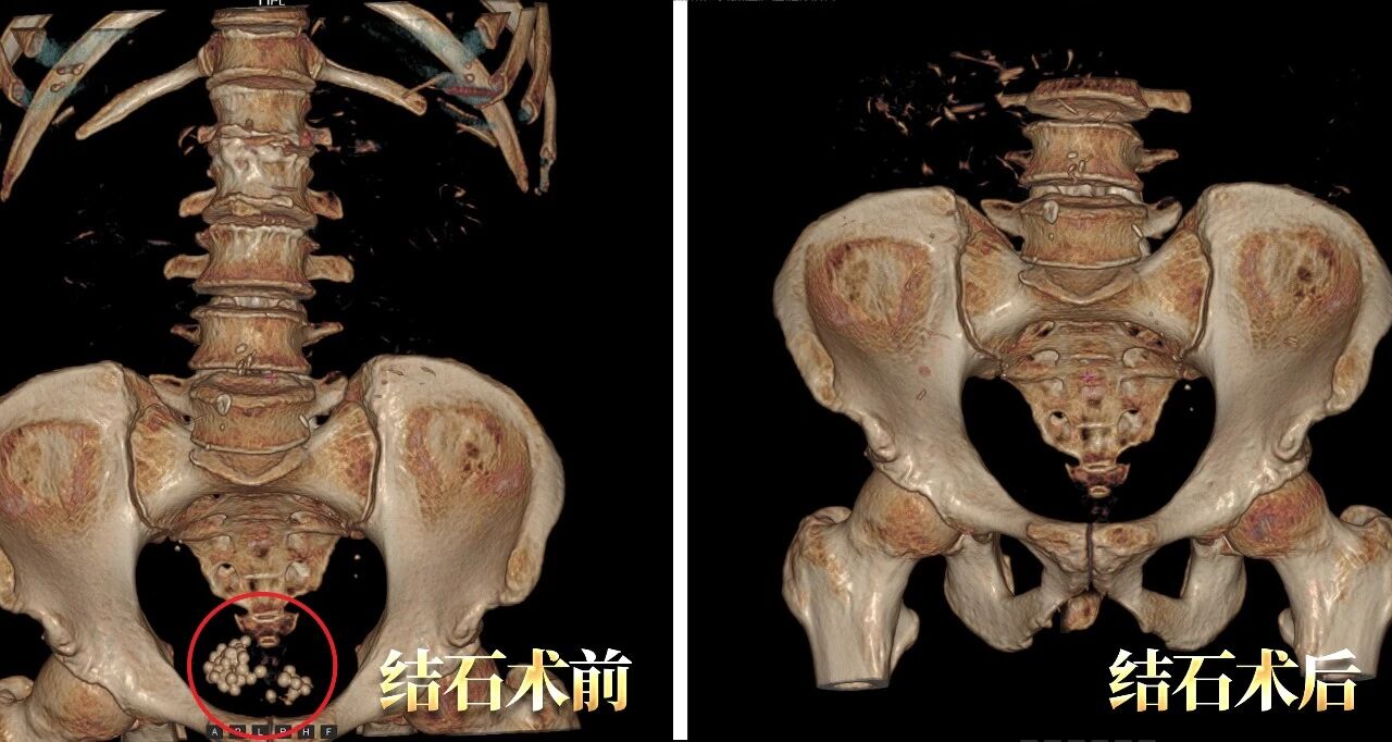 前列腺增生+膀胱结石，如何用一台手术解决？【四川结石病医院】(图2)