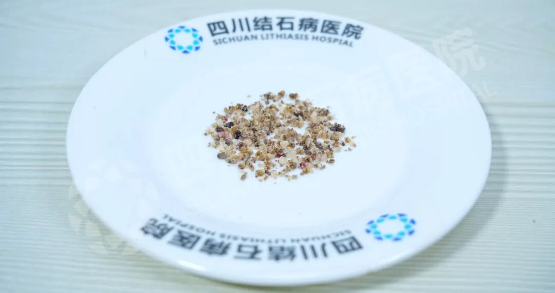 肾结石如“车厘子”般大小？别再盲目治疗了！【四川结石病医院】(图1)