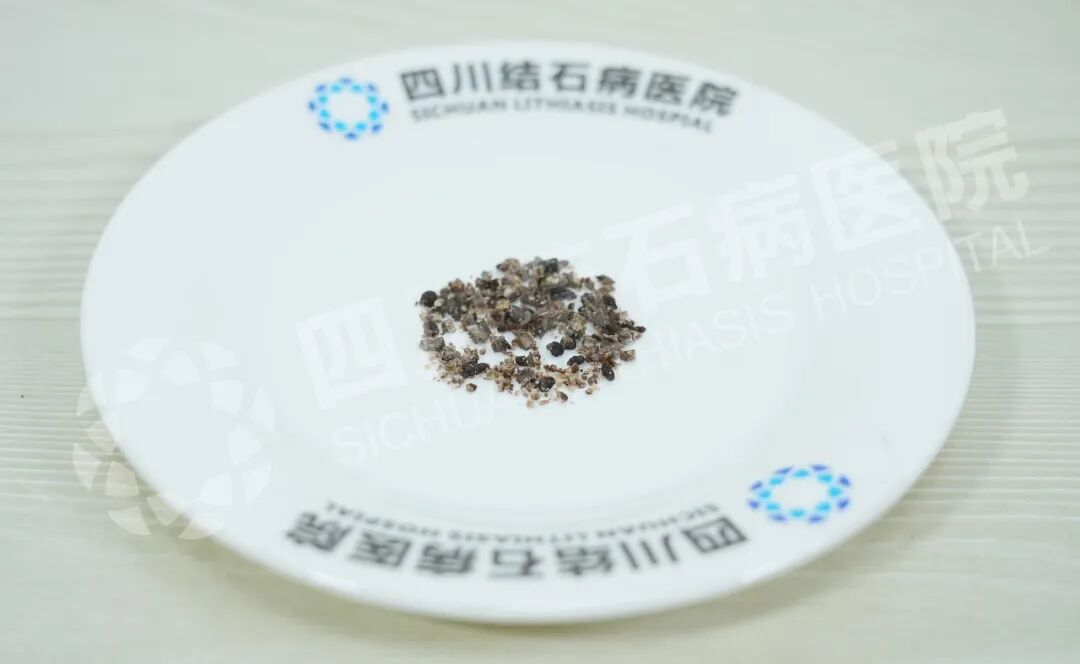 近4公分“鹿角”结石,谁说只能“打孔”取?四川肾结石医院(图2) 近4公分“鹿角”结石,谁说只能“打孔”取?四川肾结石医院(图2)