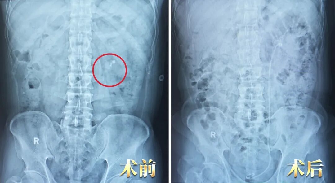 他为何十年两度托付四川结石病医院?锦旗背后藏着答案(图2) 他为何十年两度托付四川结石病医院?锦旗背后藏着答案(图2)