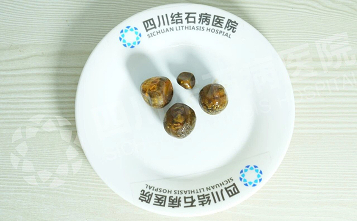 查出胆结石,为什么“早”字这么重要?四川结石病医院案例解析(图2) 查出胆结石,为什么“早”字这么重要?四川结石病医院案例解析(图2)