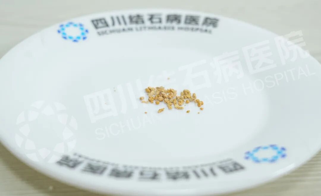 当高龄高危患者遇上胆结石，这场“硬仗”这样打赢【四川结石病医院】(图2)