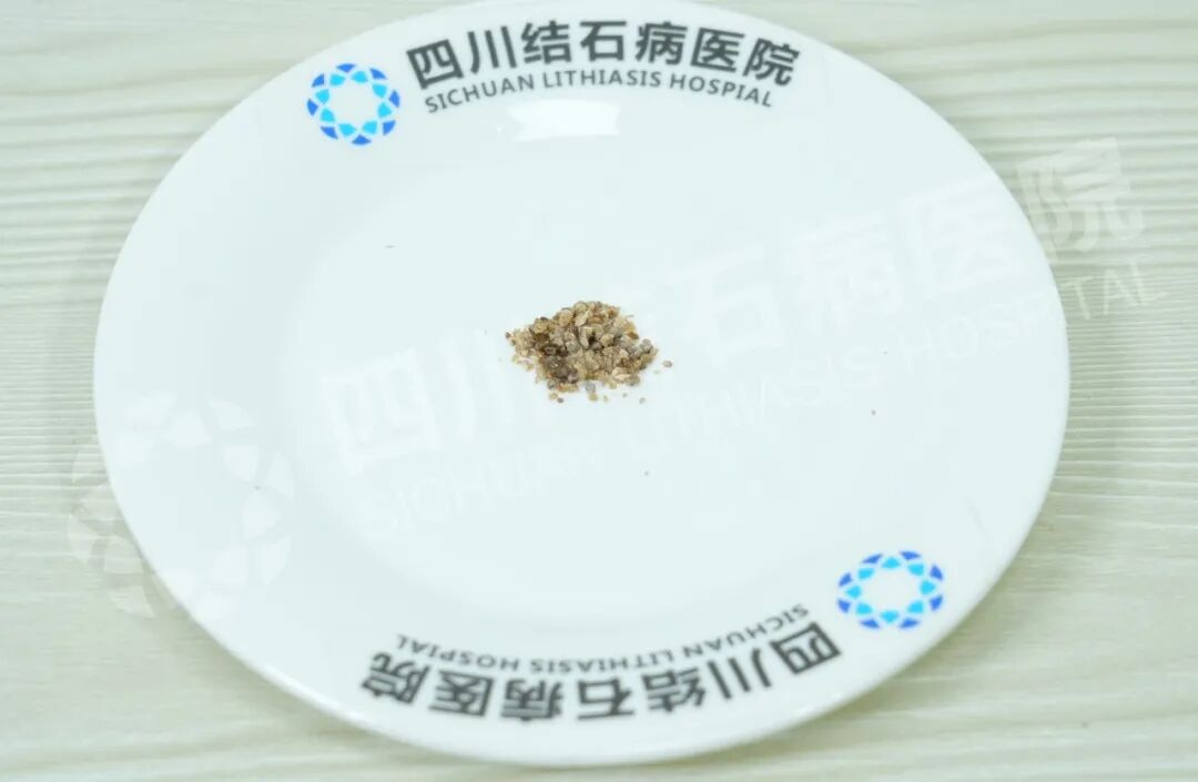 多家医院“考察”后，他为何还是回四川结石病医院治肾结石？(图1)