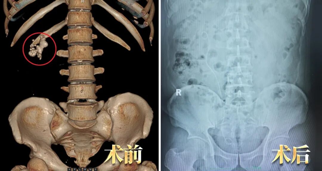 多家医院“考察”后，他为何还是回四川结石病医院治肾结石？(图2)