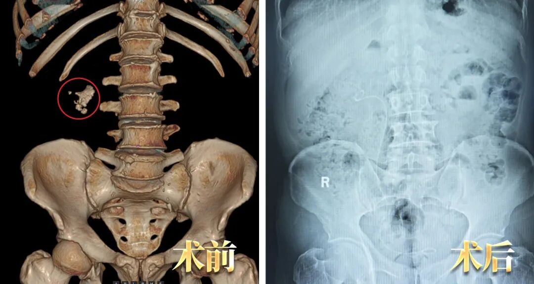 外院三战三败的结石，看四川结石病医院专家如何将它“一网打尽”？(图1)