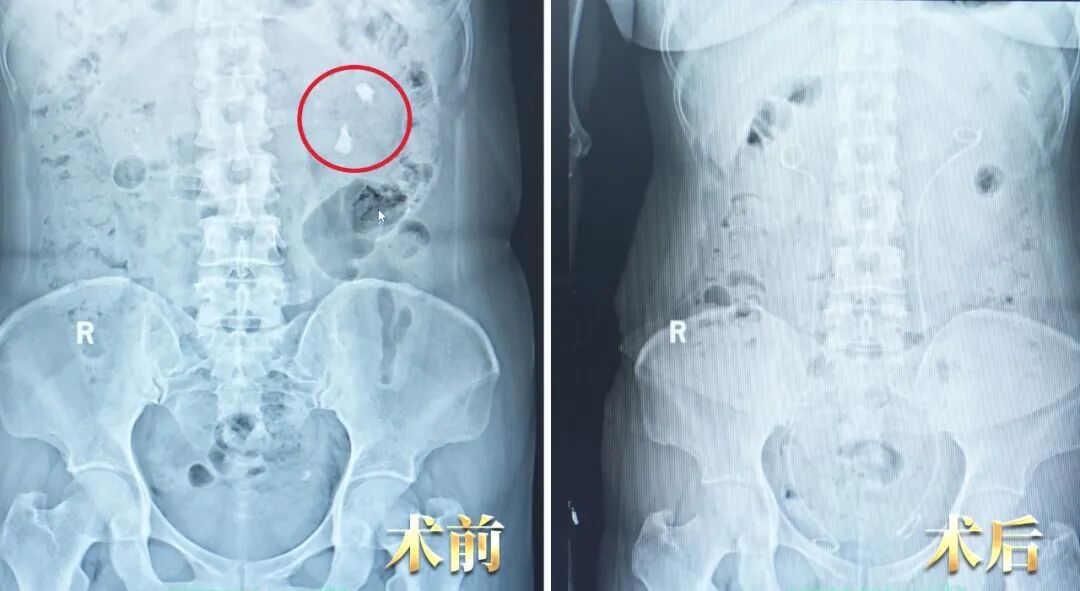 “到你们这当回家一样！”患者点赞四川结石病医院泌尿外科团队(图3)