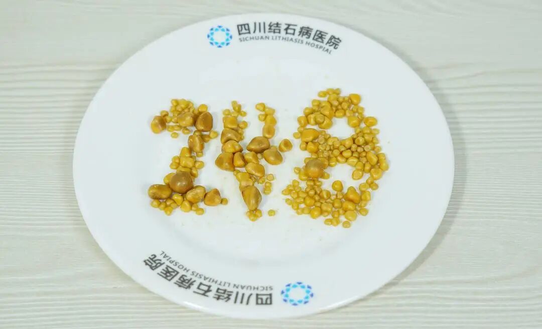 触目惊心！26岁上班族胆囊取出248颗结石，元凶竟是日常外卖(图2)