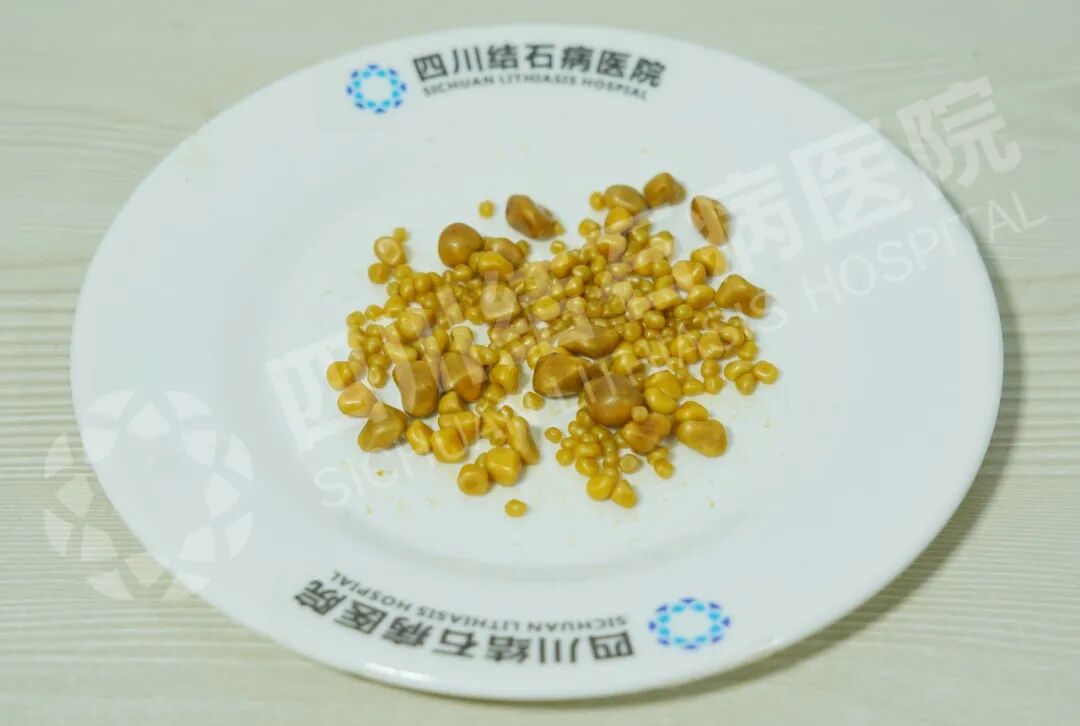 触目惊心！26岁上班族胆囊取出248颗结石，元凶竟是日常外卖(图4)