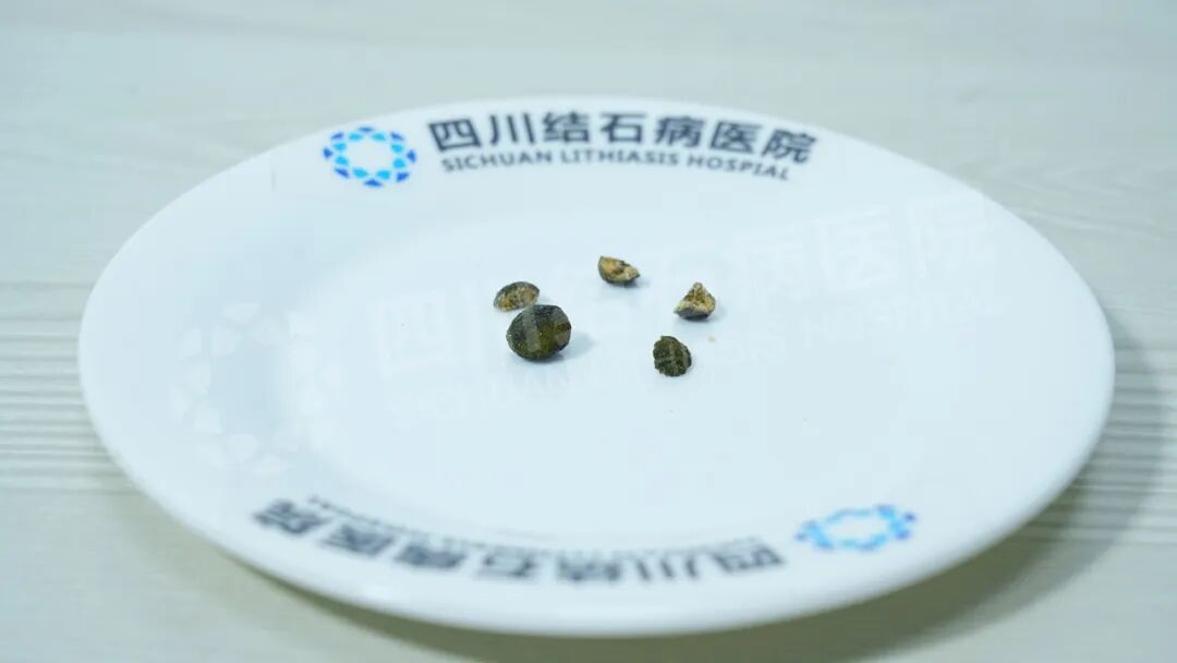 朋友的“强烈推荐”，让她从甘肃奔赴成都保胆【成都保胆取石医院】(图2)