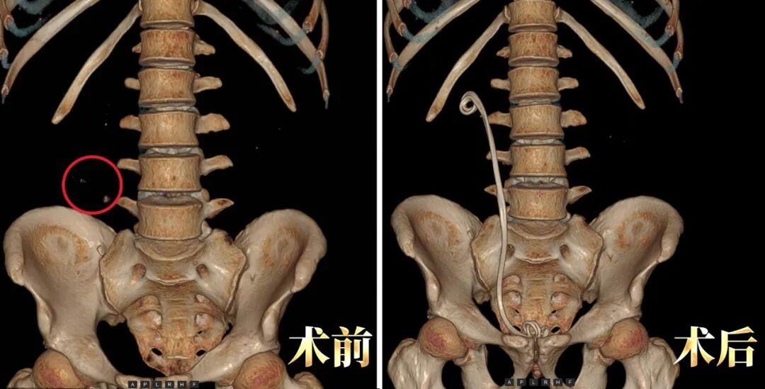 输尿管结石嵌顿，当地医生束手无策？他在我院精准解决(图2)