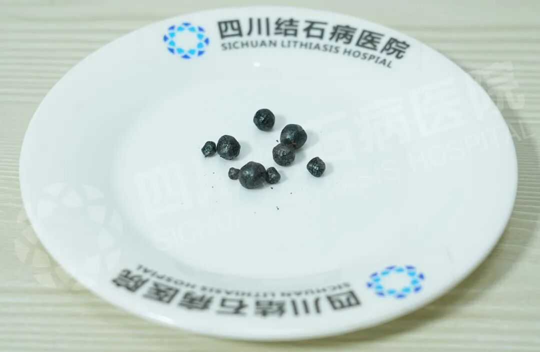 青海藏族大哥千里赴蓉 只为找陈红春主任保胆取石(图2) 青海藏族大哥千里赴蓉 只为找陈红春主任保胆取石(图2)