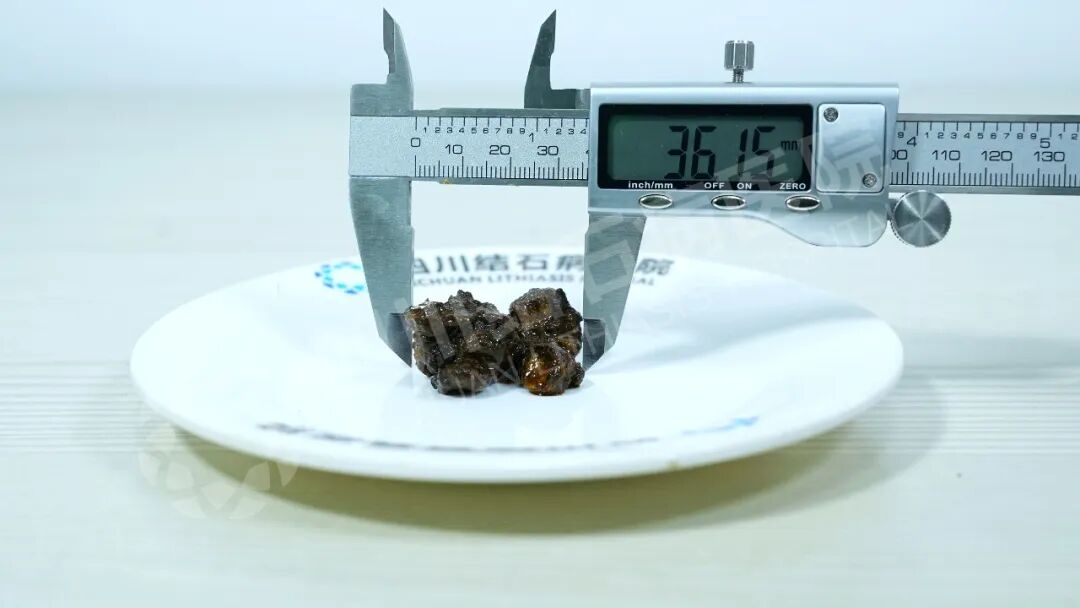 别等痛得打滚才后悔！胆结石查出后，这一步很关键【四川结石病医院】(图1)