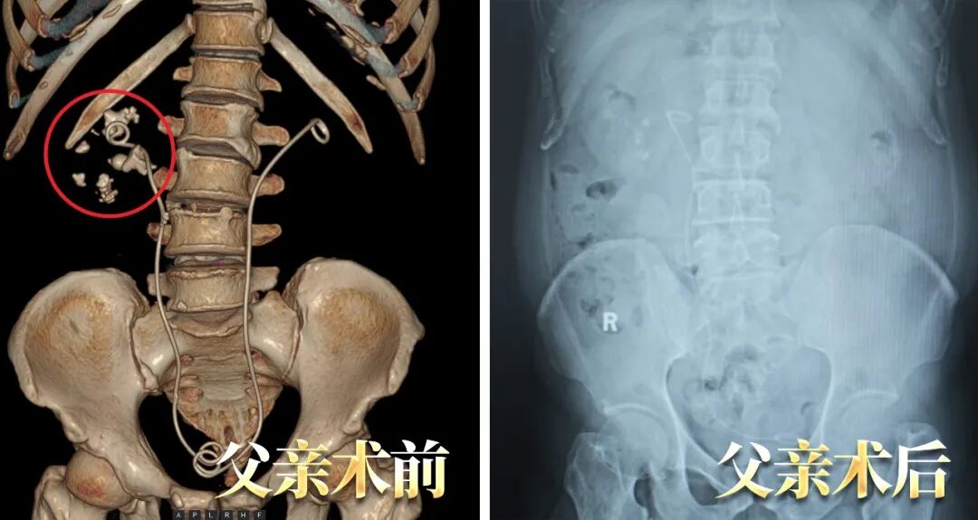 父子俩因泌尿结石同时入院!这个家庭习惯别忽视【四川肾结石医院】(图2) 父子俩因泌尿结石同时入院!这个家庭习惯别忽视【四川肾结石医院】(图2)