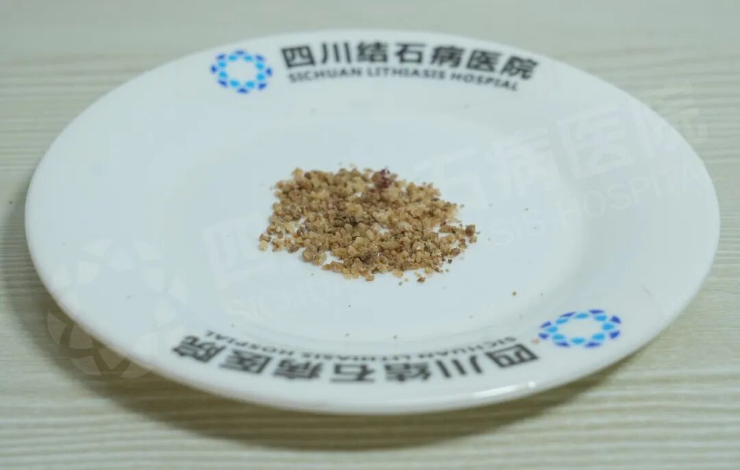 父子俩因泌尿结石同时入院!这个家庭习惯别忽视【四川肾结石医院】(图3) 父子俩因泌尿结石同时入院!这个家庭习惯别忽视【四川肾结石医院】(图3)
