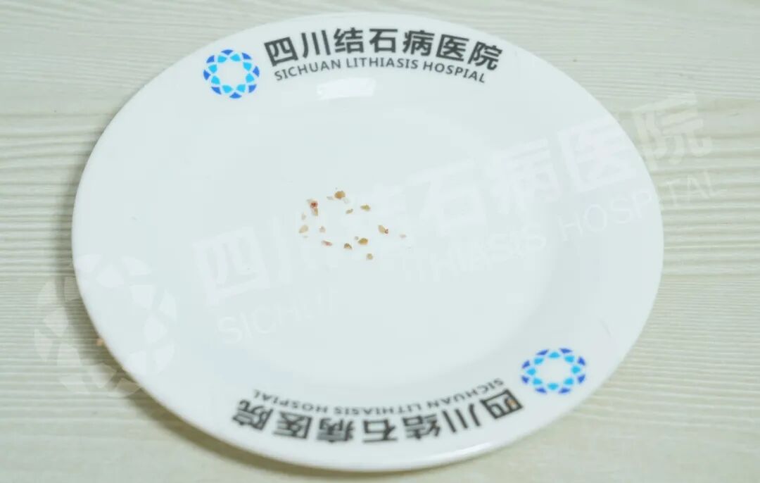 父子俩因泌尿结石同时入院!这个家庭习惯别忽视【四川肾结石医院】(图4) 父子俩因泌尿结石同时入院!这个家庭习惯别忽视【四川肾结石医院】(图4)