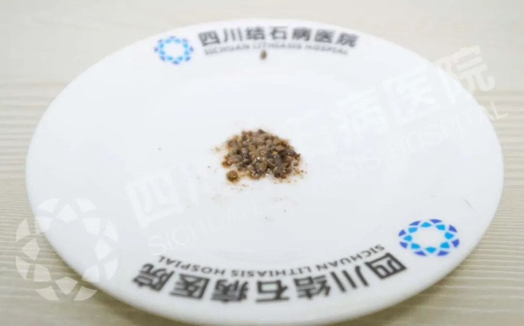 结石为何越长越多？医生说出关键【四川结石病医院】(图1)
