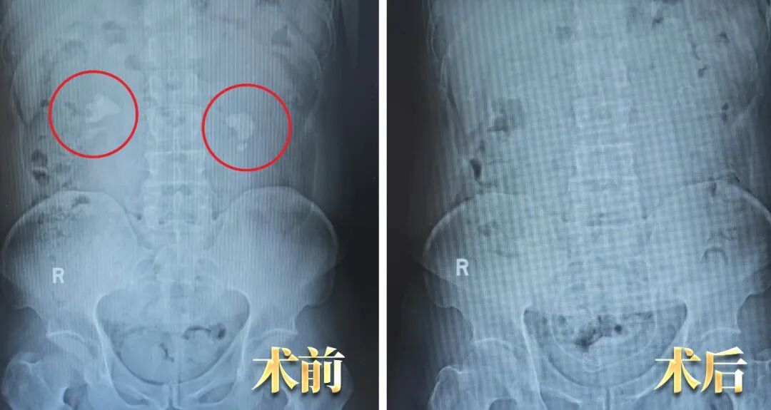 双肾大结石，外院说要腰部打孔，他却“无孔”取净？关键在这(图2)